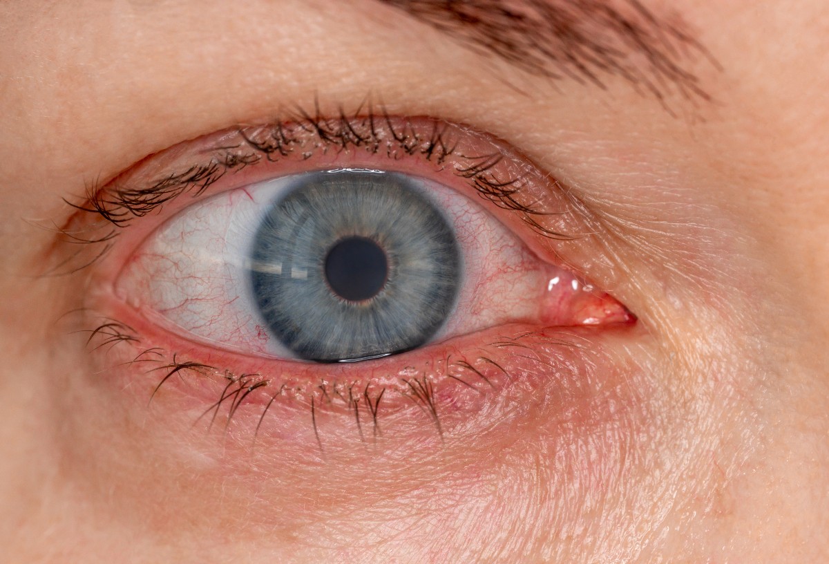 does CBD make your eyes red?